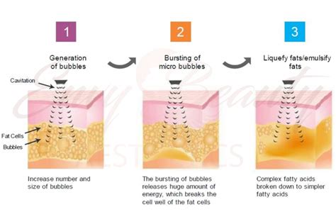 Ultrasonic Cavitation: What It Is, How It Compares to Other Fat .